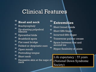 Clinical Features
 Head and neck                 Extremities
   Brachycephaly
                                   Short broad hands
   Up-slanting palpebral
    fissures                       Short fifth finger
   Epicanthal folds               Incurved fifth finger
   Brushfield spots               Transverse palmer crease
   Flat nasal bridge              Space between first and
   Folded or dysplastic ears       second toe
   Open mouth                     Hyper flexibility of joints
   Protruding tongue
   Short neck                      Life expectancy : 55 years
   Excessive skin at the nape of
    neck                            (National Down Syndrome
                                    Society)
 
