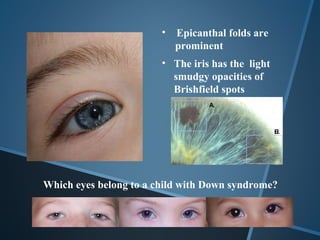 •   Epicanthal folds are
                            prominent
                        • The iris has the light
                          smudgy opacities of
                          Brishfield spots




Which eyes belong to a child with Down syndrome?
 