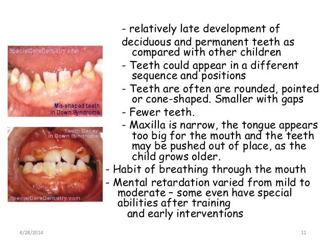 Down syndrome ppt for UGs