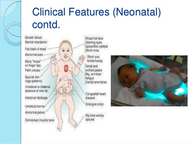 down syndrome features