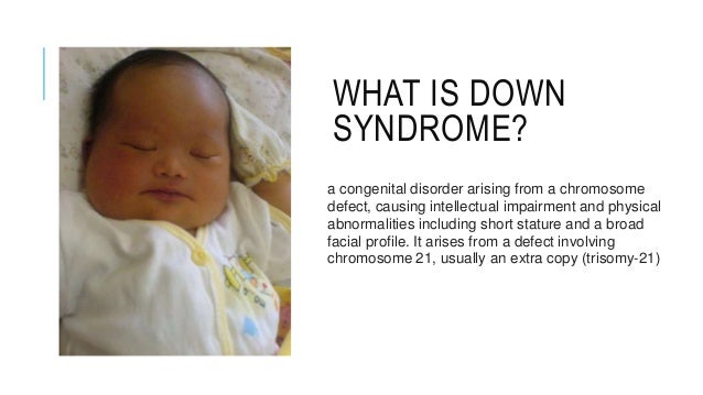 Синдром дауна у новорожденных презентация