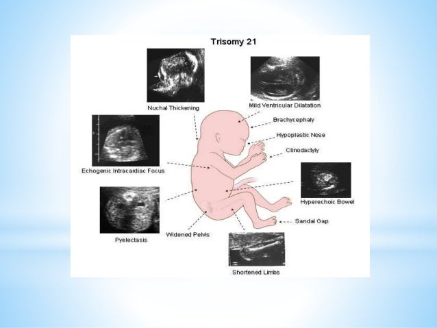 maternal age and down syndrome essay While the likelihood of giving birth to a child with down syndrome increases with maternal age coming of age with down syndrome an essay. maternal age and down syndrome essay While the likelihood of giving birth to a child with down syndrome increases with maternal age coming of age with down syndrome an essay.