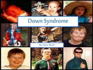 Down Syndrome
By: Aamir Sharif
 