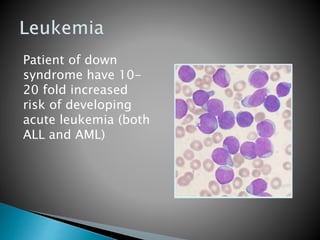 Patient of down
syndrome have 10-
20 fold increased
risk of developing
acute leukemia (both
ALL and AML)
 