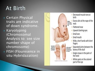  Certain Physical
traits are indicative
of down syndrome.
 Karyotyping
(Chromosomal
Analysis to see size
number shape of
chromosome)
 FISH (Flouresence in
situ Hybridazation)
 