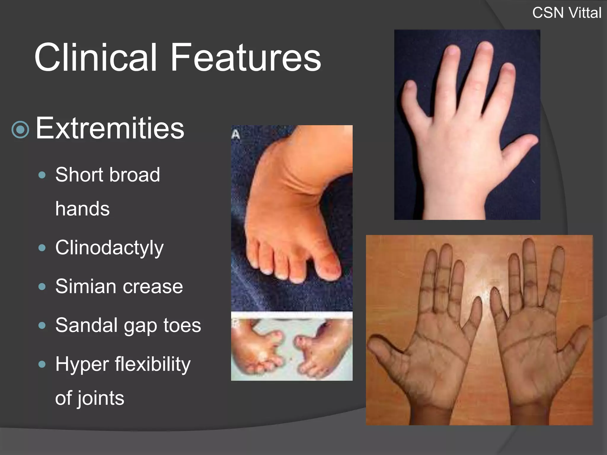 Simain Hand Down Syndrome | PPTX