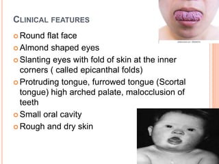 almond-shaped-eyes-down-syndrome