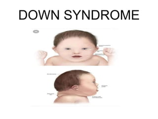 DOWN SYNDROME
 