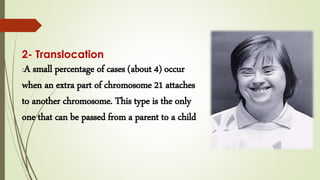 Translocation People down syndrome, Understanding Down Syndrome: A Genetic and Developmental ...