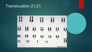 Translocation People DOWN SYNDROME.ppt Dr Venkat Krishnan Pediatrician | PDF