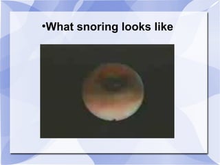 ●
What snoring looks like
 