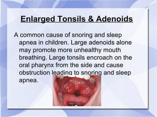 Enlarged Tonsils & Adenoids
A common cause of snoring and sleep
apnea in children. Large adenoids alone
may promote more unhealthy mouth
breathing. Large tonsils encroach on the
oral pharynx from the side and cause
obstruction leading to snoring and sleep
apnea.
 