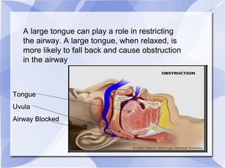 A large tongue can play a role in restricting
the airway. A large tongue, when relaxed, is
more likely to fall back and cause obstruction
in the airway
Tongue
Uvula
Airway Blocked
Tongue
Uvula
Airway Blocked
Tongue
Uvula
Airway Blocked
 