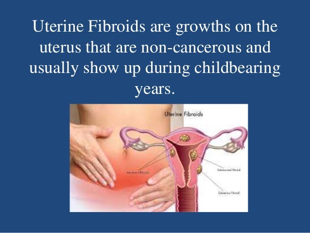 Uterine fibroids nursing diagnosis picture