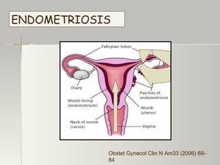 ENDOMETRIOSIS Obstet Gynecol Clin N Am33 (2006) 69– 84 