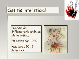 Cistitis intersticial  Condición inflamatoria crónica de la vejiga. 5 casos por 1000 Mujeres 10 : 1 hombres 