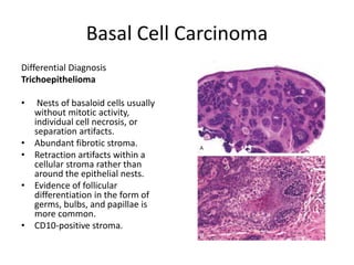 Basal Cell Carcinoma
Differential Diagnosis
Trichoepithelioma
• Nests of basaloid cells usually
without mitotic activity,
individual cell necrosis, or
separation artifacts.
• Abundant fibrotic stroma.
• Retraction artifacts within a
cellular stroma rather than
around the epithelial nests.
• Evidence of follicular
differentiation in the form of
germs, bulbs, and papillae is
more common.
• CD10-positive stroma.
 