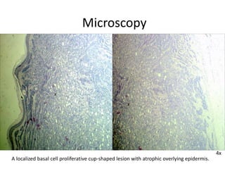 Microscopy
4x
A localized basal cell proliferative cup-shaped lesion with atrophic overlying epidermis.
 