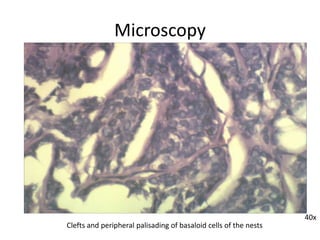 Microscopy
40x
Clefts and peripheral palisading of basaloid cells of the nests
 