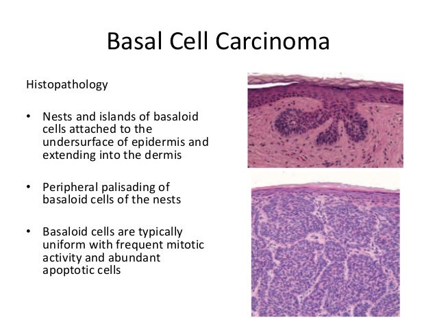 Basal Cell Carcinoma Presented By Dr Varughese