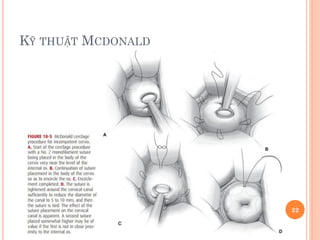 KỸ THUẬT MCDONALD
22
 
