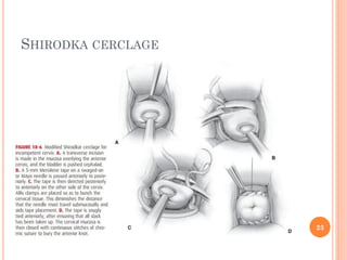 SHIRODKA CERCLAGE
23
 