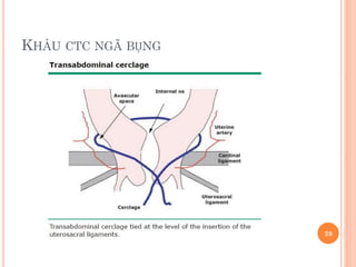 KHÂU CTC NGÃ BỤNG
28
 