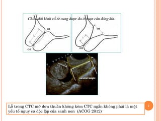 7Lỗ trong CTC mở đơn thuần không kèm CTC ngắn không phải là một
yếu tố nguy cơ độc lập của sanh non (ACOG 2012)
 