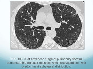Ipf Radiopaedia Diffuse Parenchymal Lung Diseases | PPTX
