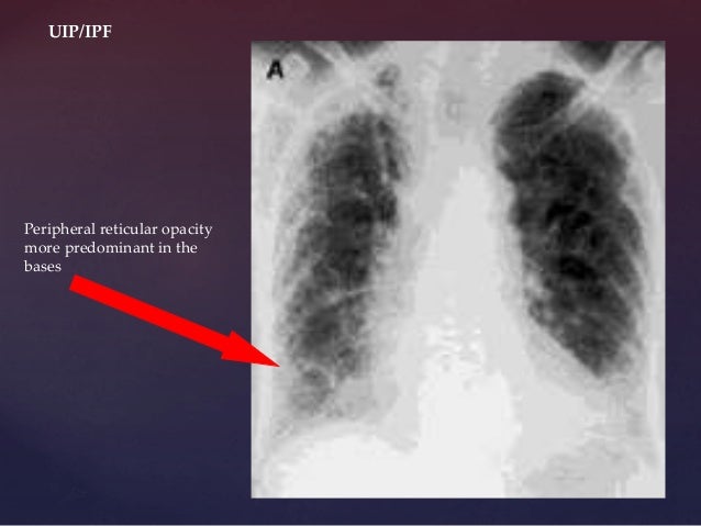 Image Result For What Is Interstitial Lung Disease Image Result For What Is Interstitial Lung Disease