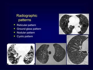 Alveolar Pattern Rcc approach to interstitial lung disease | PPTX