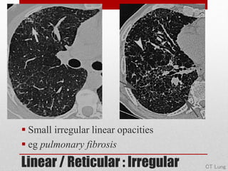 Diffuse Parenchymal Lung Disease : Radiological Approach | PPTX