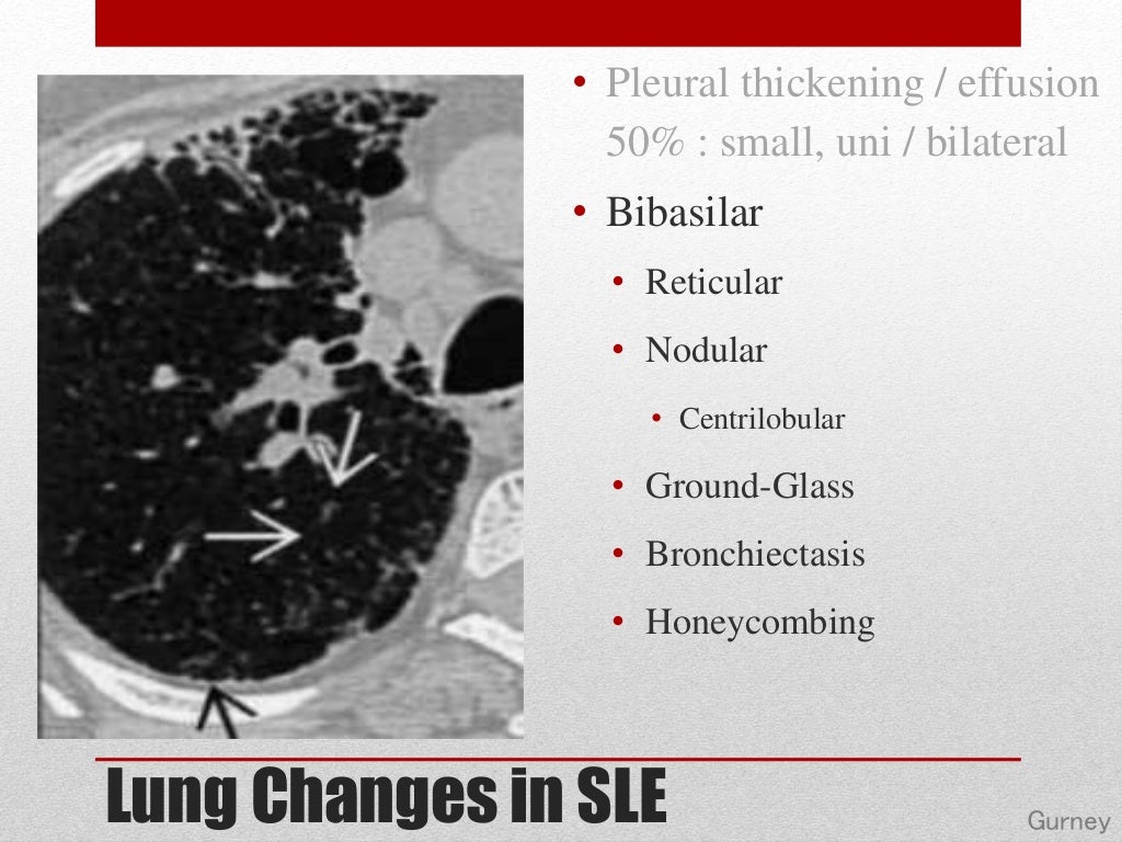 Diffuse Parenchymal Lung Disease Radiological Approach