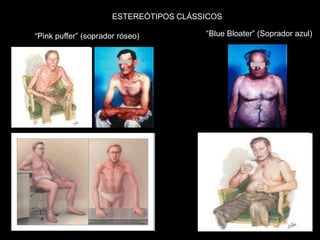 ESTEREÓTIPOS CLÁSSICOS

“Pink puffer” (soprador róseo)          “Blue Bloater” (Soprador azul)
 