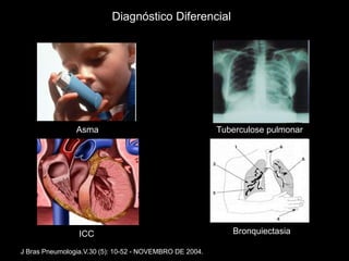 Diagnóstico Diferencial




                Asma                                     Tuberculose pulmonar




                 ICC                                        Bronquiectasia

J Bras Pneumologia.V.30 (5): 10-52 - NOVEMBRO DE 2004.
 