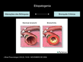 Etiopatogenia

 Alterações dos Brônquios                                Bronquite Crônica




J Bras Pneumologia.V.30 (5): 10-52 - NOVEMBRO DE 2004.
 
