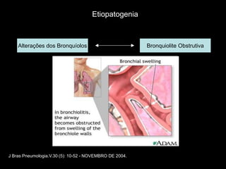 Etiopatogenia



    Alterações dos Bronquíolos                           Bronquiolite Obstrutiva




J Bras Pneumologia.V.30 (5): 10-52 - NOVEMBRO DE 2004.
 