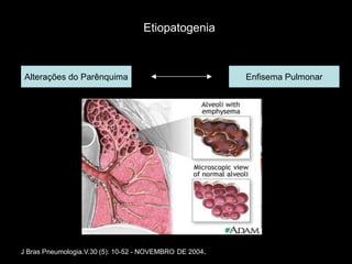 Etiopatogenia



 Alterações do Parênquima                                Enfisema Pulmonar




J Bras Pneumologia.V.30 (5): 10-52 - NOVEMBRO DE 2004.
 