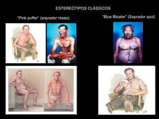 “ Pink puffer” (soprador róseo) “ Blue Bloater” (Soprador azul) ESTEREÓTIPOS CLÁSSICOS 