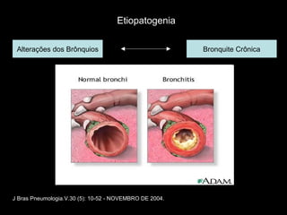 Alterações dos Brônquios Bronquite Crônica Etiopatogenia J Bras Pneumologia.V.30 (5): 10-52 - NOVEMBRO DE 2004. 