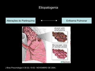 Alterações do Parênquima Enfisema Pulmonar J Bras Pneumologia.V.30 (5): 10-52 - NOVEMBRO   DE 2004 . Etiopatogenia 
