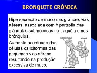 BRONQUITE CRÔNICA
 