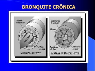 BRONQUITE CRÔNICA
 