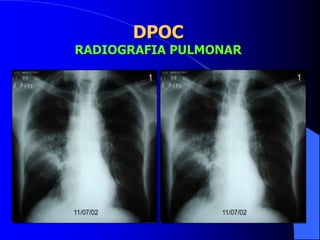 DPOC
RADIOGRAFIA PULMONAR
 