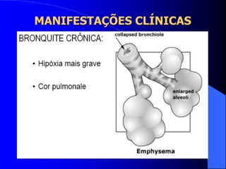 MANIFESTAÇÕES CLÍNICAS
 