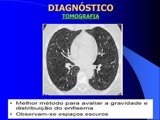 DIAGNÓSTICO
TOMOGRAFIA
 