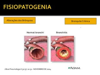 Alterações dos Brônquios Bronquite Crônica
J Bras Pneumologia.V.30 (5): 10-52 - NOVEMBRO DE 2004.
 
