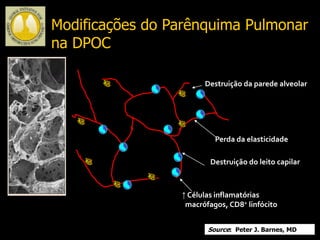 Destruição da parede alveolar
Perda da elasticidade
Destruição do leito capilar
↑ Células inflamatórias
macrófagos, CD8+ linfócito
Source: Peter J. Barnes, MD
Modificações do Parênquima Pulmonar
na DPOC
 