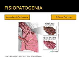 Alterações do Parênquima Enfisema Pulmonar
J Bras Pneumologia.V.30 (5): 10-52 - NOVEMBRO DE 2004.
 