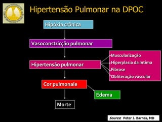 Hipóxia crônica
Vasoconstricção pulmonar
Muscularização
Hiperplasia da Intima
Fibrose
Obliteração vascular
Hipertensão pulmonar
Cor pulmonale
Morte
Edema
Hipertensão Pulmonar na DPOC
Source: Peter J. Barnes, MD
 